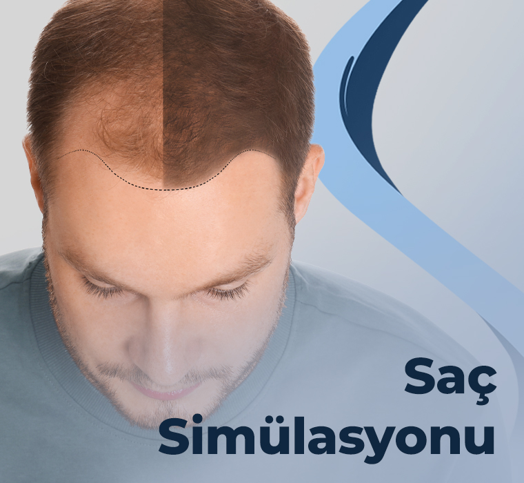 Saç Simülasyonu ve Karma Saç Ekimi