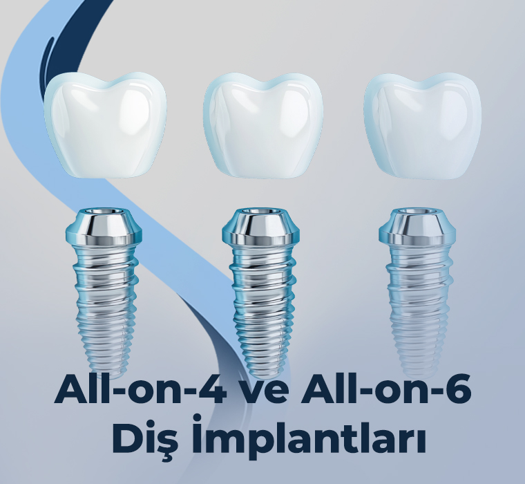 All-on-4 ve All-on-6 Diş İmplantları