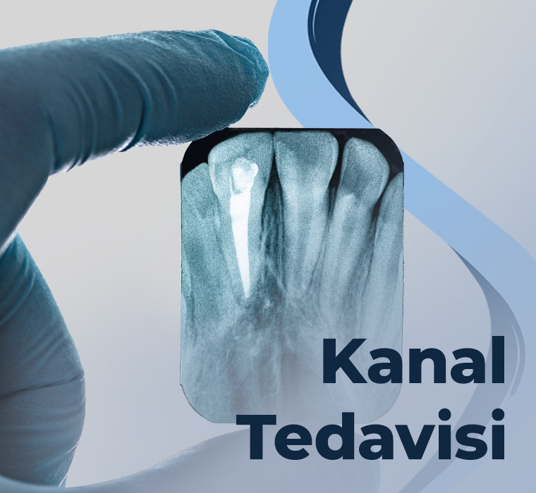 Kanal Tedavisi
