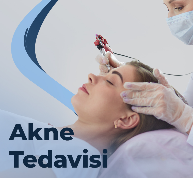 Akne Tedavisi