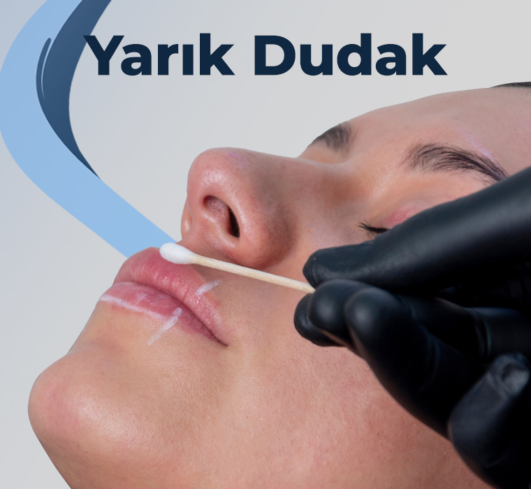 Yarık Dudak